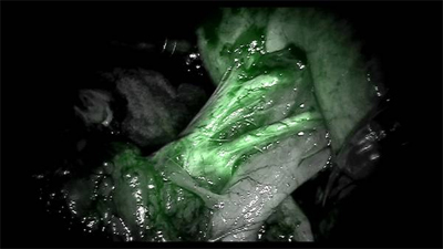 © (2013) Intuitive Surgical, Inc. Dye injected into the patient shows up under the da Vinci robot's specialised camera as bright green light, giving the technology its 'Firefly' name
