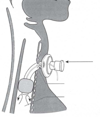 Incorrect Speaking valve used in the presence of an inflated cuff preventing exhalation