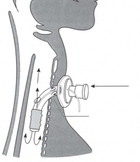 Correct Speaking valve with cuff deflated