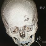 Traumatic brain injury