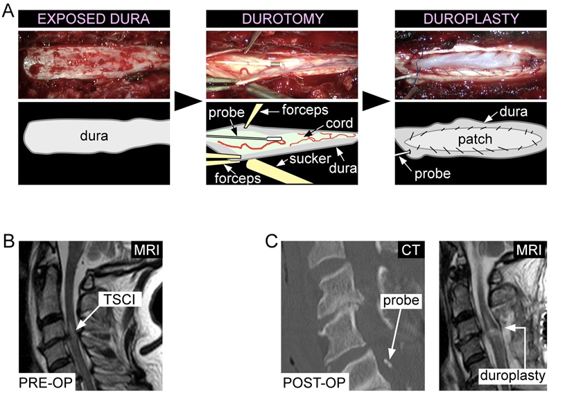 Duroplasty technique