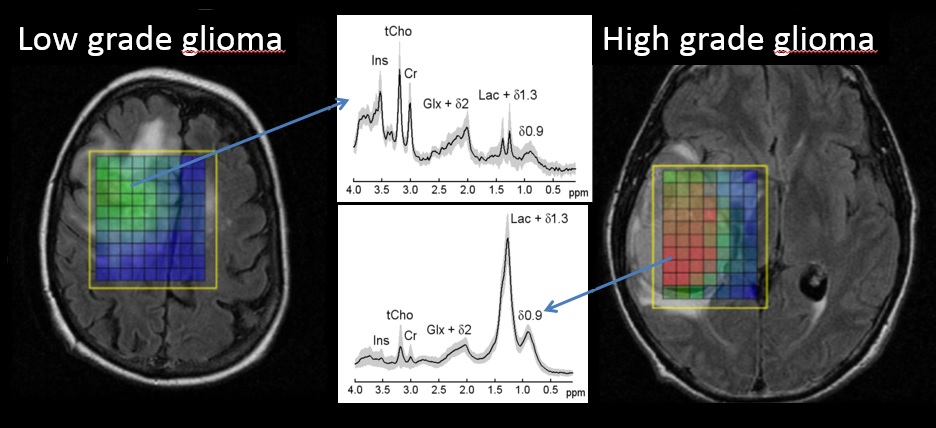 Prof. Franklyn Howe: MR Spectroscopy of brain tumours.