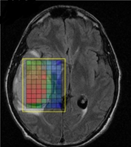 High grade glioma