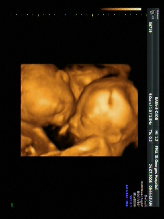 Ideal time to deliver twins is discovered - St George's University  Hospitals NHS Foundation Trust