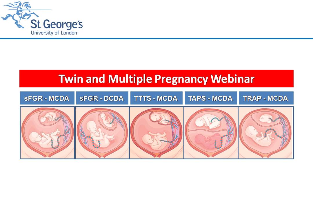 presentation of twin pregnancy