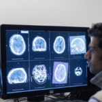 St George’s runs England’s first ever international thrombectomy trial