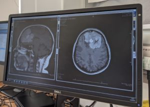 Caroline had a CT scan on New Year’s Eve which revealed she had a Grade 2 atypical meningioma tumour.