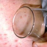 Meningitis outbreak: signs and symptoms